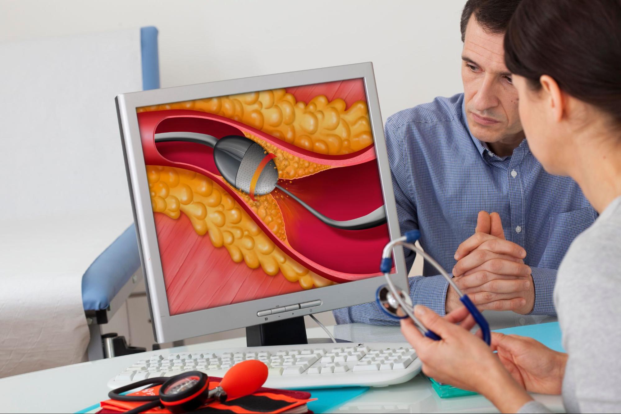 What are the Advantages of an Atherectomy Procedure